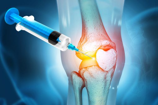 Knee gel injection applied on knee in Pearland, Texas.