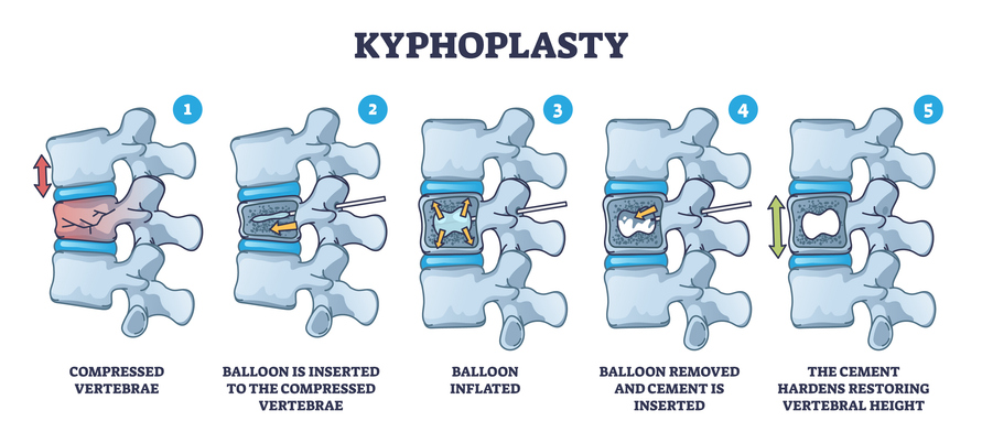 Kyphoplasty Invasive Surgery for Spinal Compression in Pearland, TX
