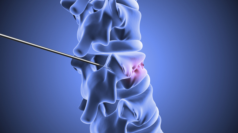 Vertebroplasty Treatment in Pearland, TX