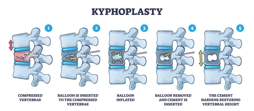 Kyphoplasty Invasive Surgery for Spinal Compression in Pearland, TX